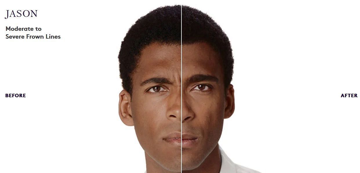 Jason had fewer frown lines after this treatment (Image via Botox Cosmetic)